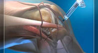 Ορθοπεδική έγχυση προϊόντων &amp; Hyaluronic όξινη έγχυση γονάτων οργάνων οπής